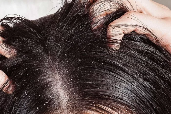 دلیل شوره زدن مو پس از کراتینه کردن چیست؟