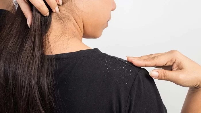 دلیل شوره زدن مو پس از کراتینه کردن چیست؟