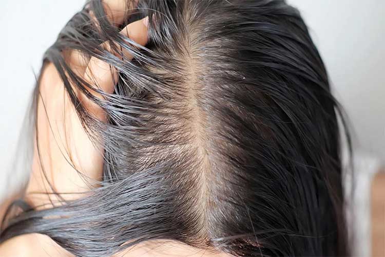 علت چرب شدن و ریزش مو بعد از کراتینه